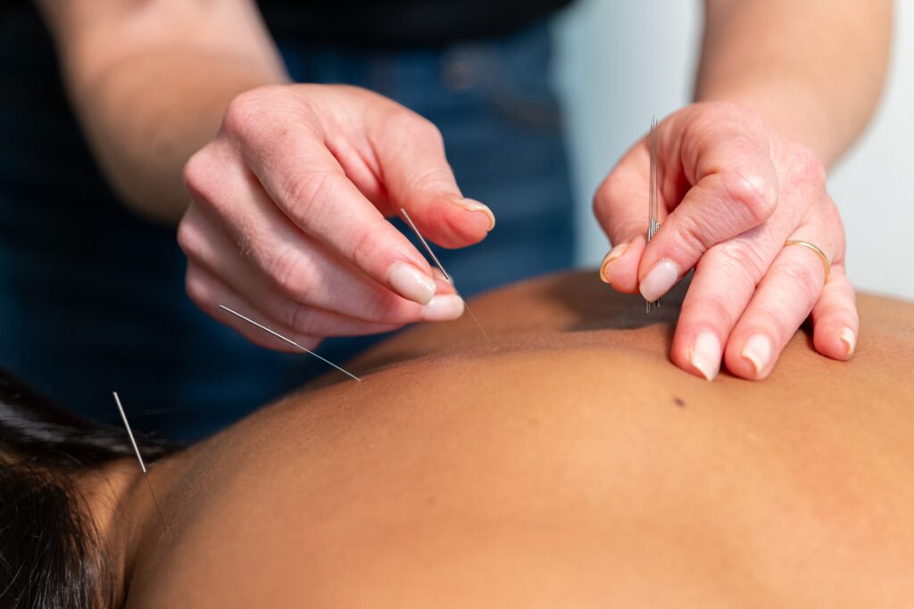 Practitioner performing acupuncture at a North Shore wellness clinic